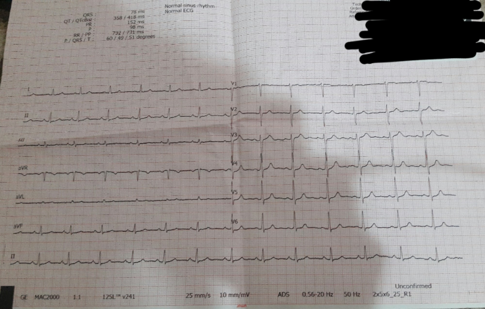 A printed electrocardiogram showing a recorded heart rhythm; medical context for cardiac measurement, not ScareScore data